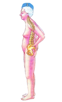 Osteoporoza - zrzeszotnienie